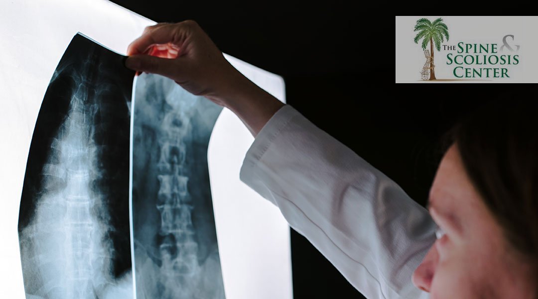 Symptoms of Myelopathy The Spine and Scoliosis Center